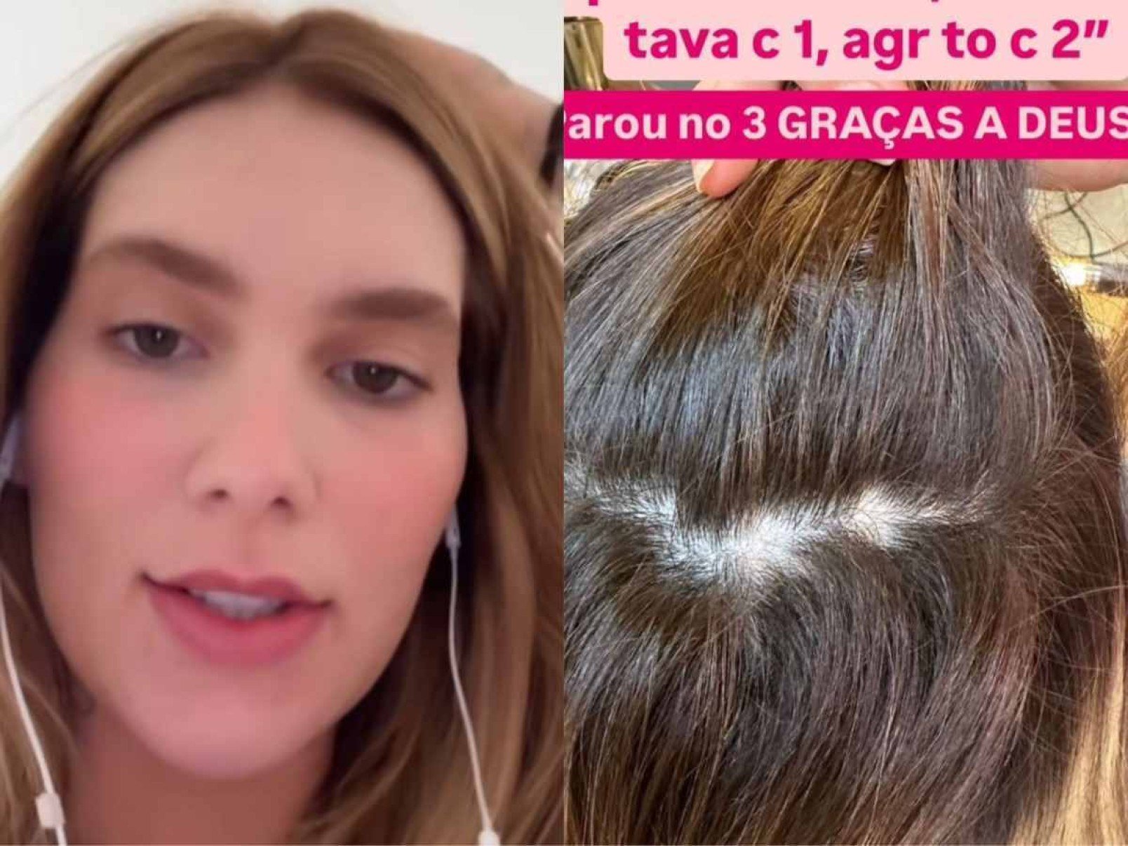 Virginia abre o jogo sobre seu tratamento contra alopecia