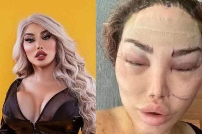 Jéssica Alves, ex-Ken Humano, exibe nova cirurgia no rosto - (crédito: Reprodução Instagram ) Jéssica Alves, ex-Ken Humano, exibe nova cirurgia no rosto - (crédito: Reprodução Instagram )