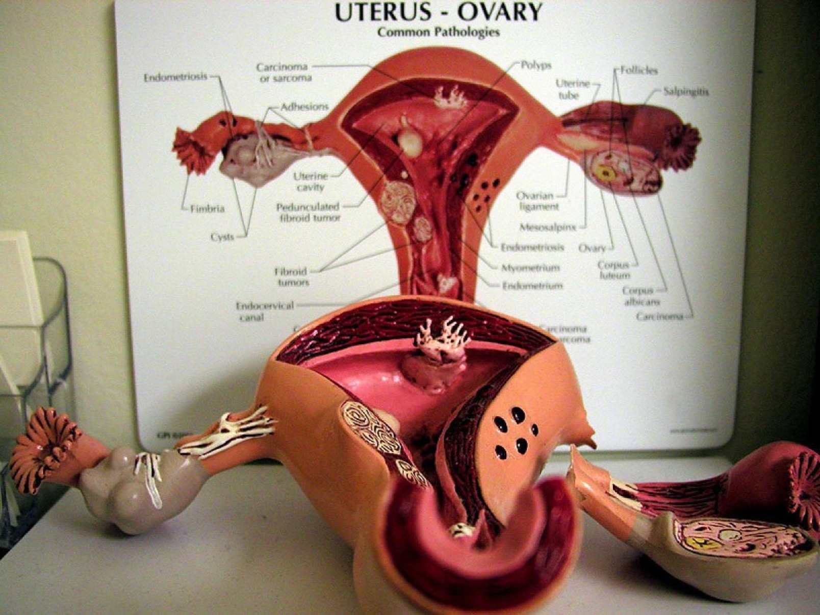 Endometriose e mioma aumentam risco de morte precoce 