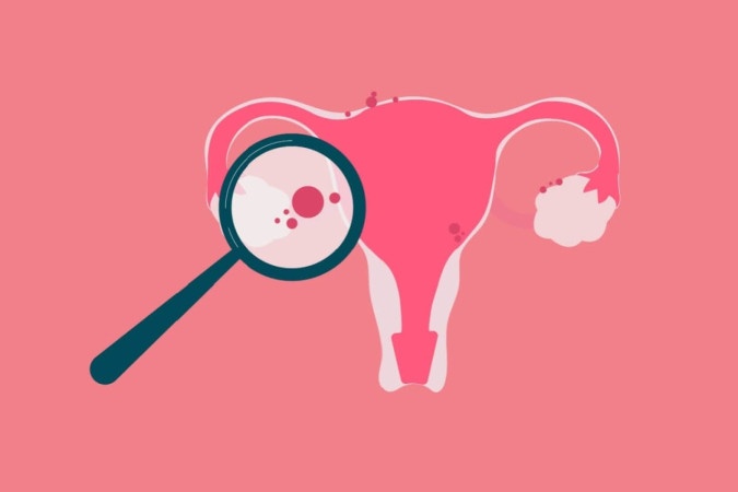 Com sintomas confundidos com outras condições, a endometriose exige acompanhamento especializado (Imagem: Gegambar | Shutterstock) -  (crédito: EdiCase)