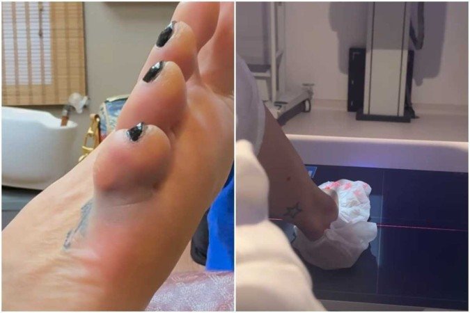 Luciana Gimenez mostrou o dedo inchado nas redes sociais