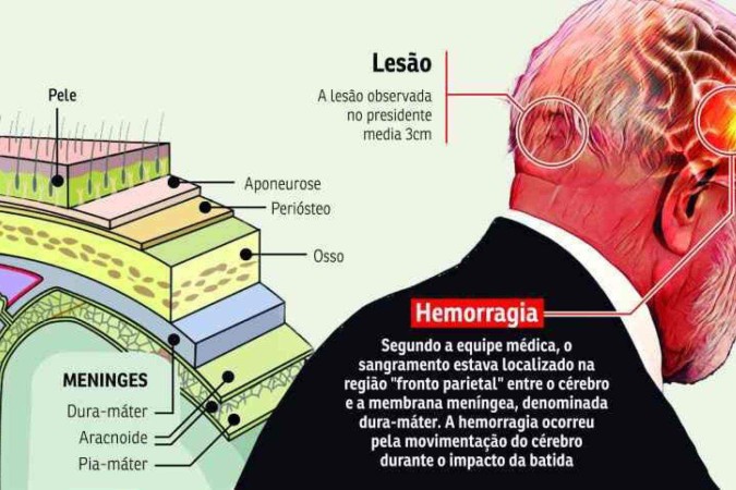 Lula Cirurgia