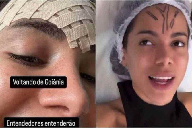 Anitta fala sobre cirurgia na testa - (crédito: Reprodução Instagram ) Anitta fala sobre cirurgia na testa - (crédito: Reprodução Instagram )