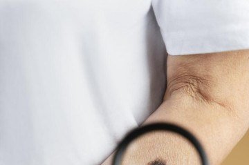 As manchas podem aparecer como pintas, feridas, verrugas ou outras lesões