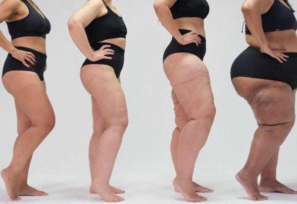ONG Movimento Lipedema/Conheça Lipedema