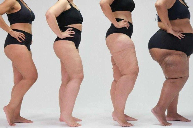 Paciente mostra a diferença causada pelo lipedema no formato de seu corpo em foto de campanha de conscientização da doença feita pela ONG Movimento Lipedema - (crédito: ONG Movimento Lipedema/Conheça Lipedema) Paciente mostra a diferença causada pelo lipedema no formato de seu corpo em foto de campanha de conscientização da doença feita pela ONG Movimento Lipedema - (crédito: ONG Movimento Lipedema/Conheça Lipedema)