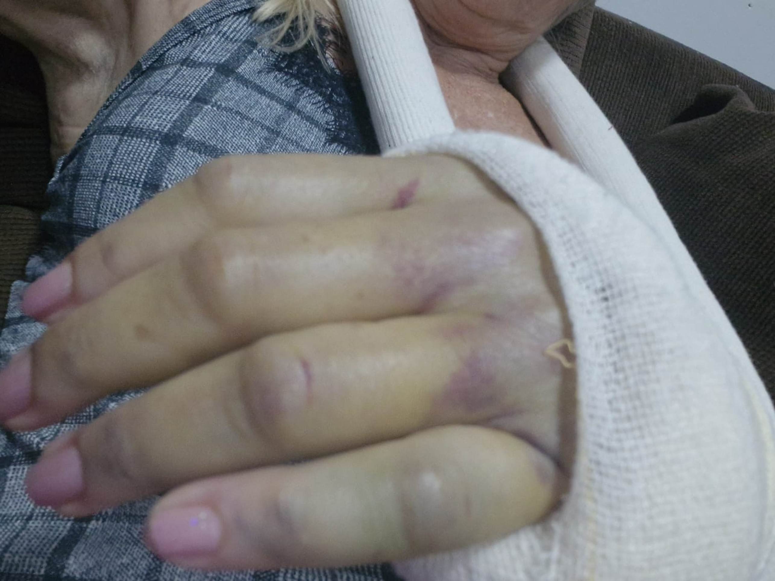 Pitbull solto ataca moradora e causa fratura exposta em Samambaia 
