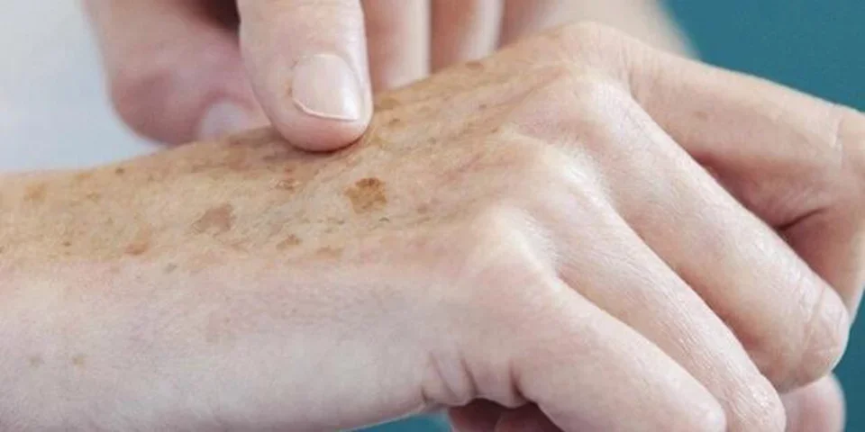 Tudo o que você precisa saber sobre o tumor mais comum no Brasil - Agência Brasil