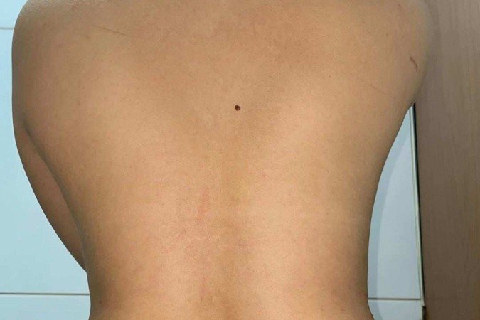 Jovem divulgou fotos das marcas pelo corpo - (crédito: Arquivo pessoal) Jovem divulgou fotos das marcas pelo corpo - (crédito: Arquivo pessoal)