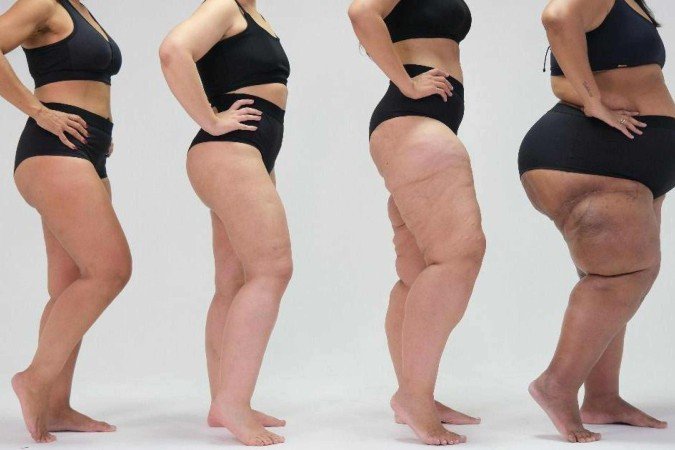Paciente mostra a diferença causada pelo lipedema no formato de seu corpo em foto de campanha de conscientização da doença feita pela ONG Movimento Lipedema - (crédito: ONG Movimento Lipedema/Conheça Lipedema) Paciente mostra a diferença causada pelo lipedema no formato de seu corpo em foto de campanha de conscientização da doença feita pela ONG Movimento Lipedema - (crédito: ONG Movimento Lipedema/Conheça Lipedema)