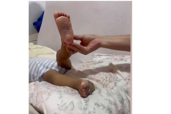 Mãe mostrou, em vídeo, situação das queimaduras do filho - (crédito: Redes sociais) Mãe mostrou, em vídeo, situação das queimaduras do filho - (crédito: Redes sociais)