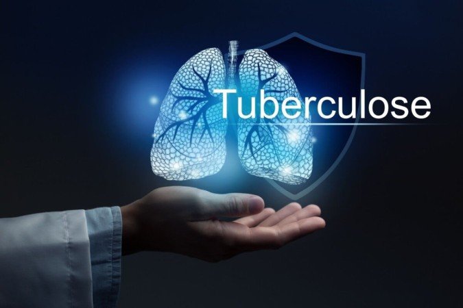 A tuberculose é uma doença infecciosa que afeta principalmente os pulmões (Imagem: mi_viri | Shutterstock) - (crédito: EdiCase) A tuberculose é uma doença infecciosa que afeta principalmente os pulmões (Imagem: mi_viri | Shutterstock) - (crédito: EdiCase)