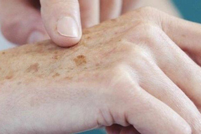 Tipo mais grave de câncer de pele, o melanoma pode ser confundido com uma mancha inofensiva no início, o que dificulta a detecção -  (crédito: Agência Brasil)