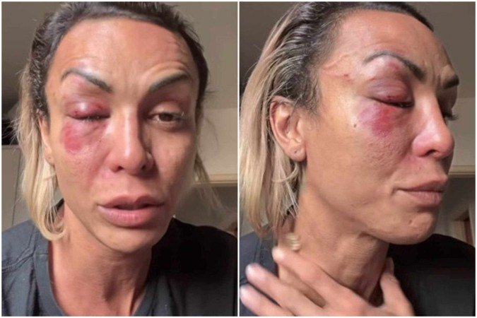 A comunicadora ficou com hematomas no olho após a agressão - (crédito: Reprodução/Instagram/@izabellipotter) A comunicadora ficou com hematomas no olho após a agressão - (crédito: Reprodução/Instagram/@izabellipotter)