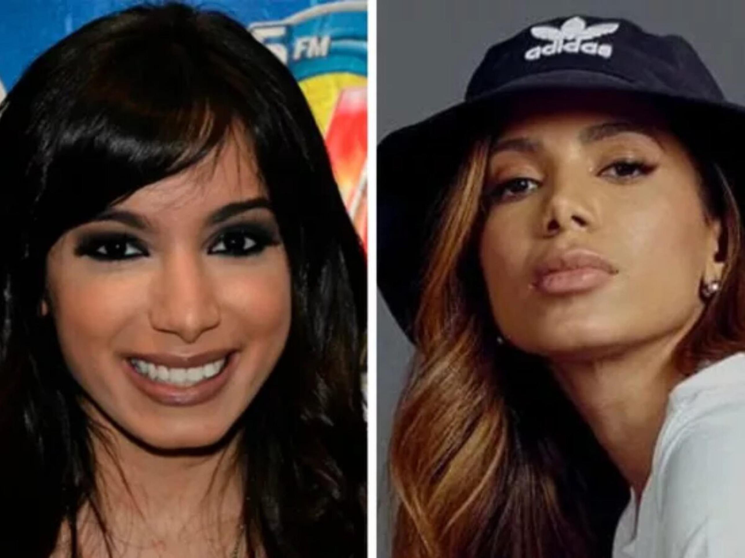 Todas as cirurgias plásticas de Anitta - (crédito: Observatorio dos Famosos) Todas as cirurgias plásticas de Anitta - (crédito: Observatorio dos Famosos)