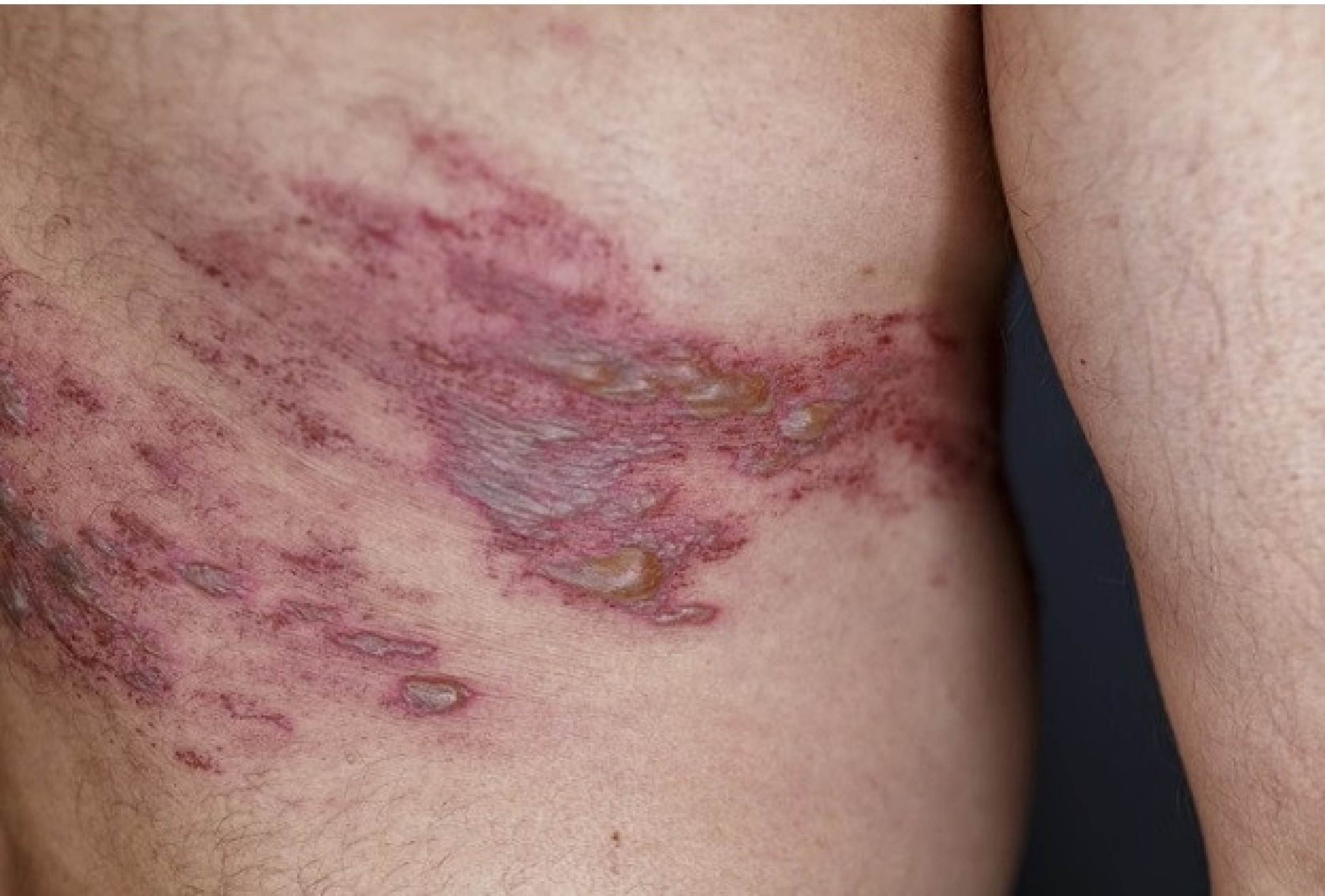 Saiba quais são os perigos do herpes-zóster e as formas de prevenção