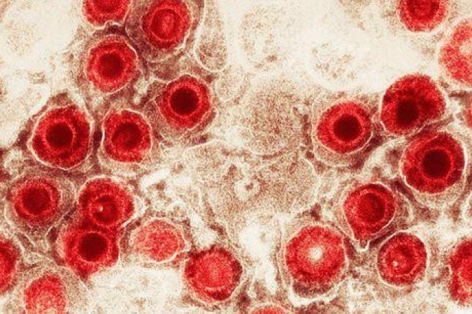 O herpes zoster acontece pela reativação do vírus varicela, que inicialmente causa a catapora - (crédito: Getty Images) O herpes zoster acontece pela reativação do vírus varicela, que inicialmente causa a catapora - (crédito: Getty Images)
