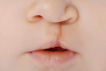 Também conhecida como lábio leporino, a fissura labiopalatina pode ser corrigida com cirurgia
 -  (crédito: Getty Images/iStockphoto)