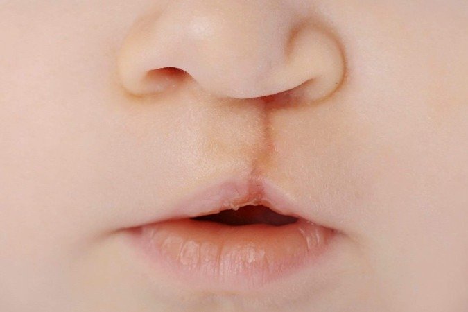 Também conhecida como lábio leporino, a fissura labiopalatina pode ser corrigida com cirurgia
- (crédito: Getty Images/iStockphoto) Também conhecida como lábio leporino, a fissura labiopalatina pode ser corrigida com cirurgia
- (crédito: Getty Images/iStockphoto)