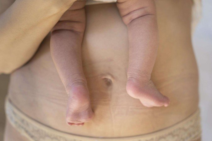 A diástase pode afetar a qualidade de vida no pós-parto - (crédito: Reprodução/ Freepik) A diástase pode afetar a qualidade de vida no pós-parto - (crédito: Reprodução/ Freepik)