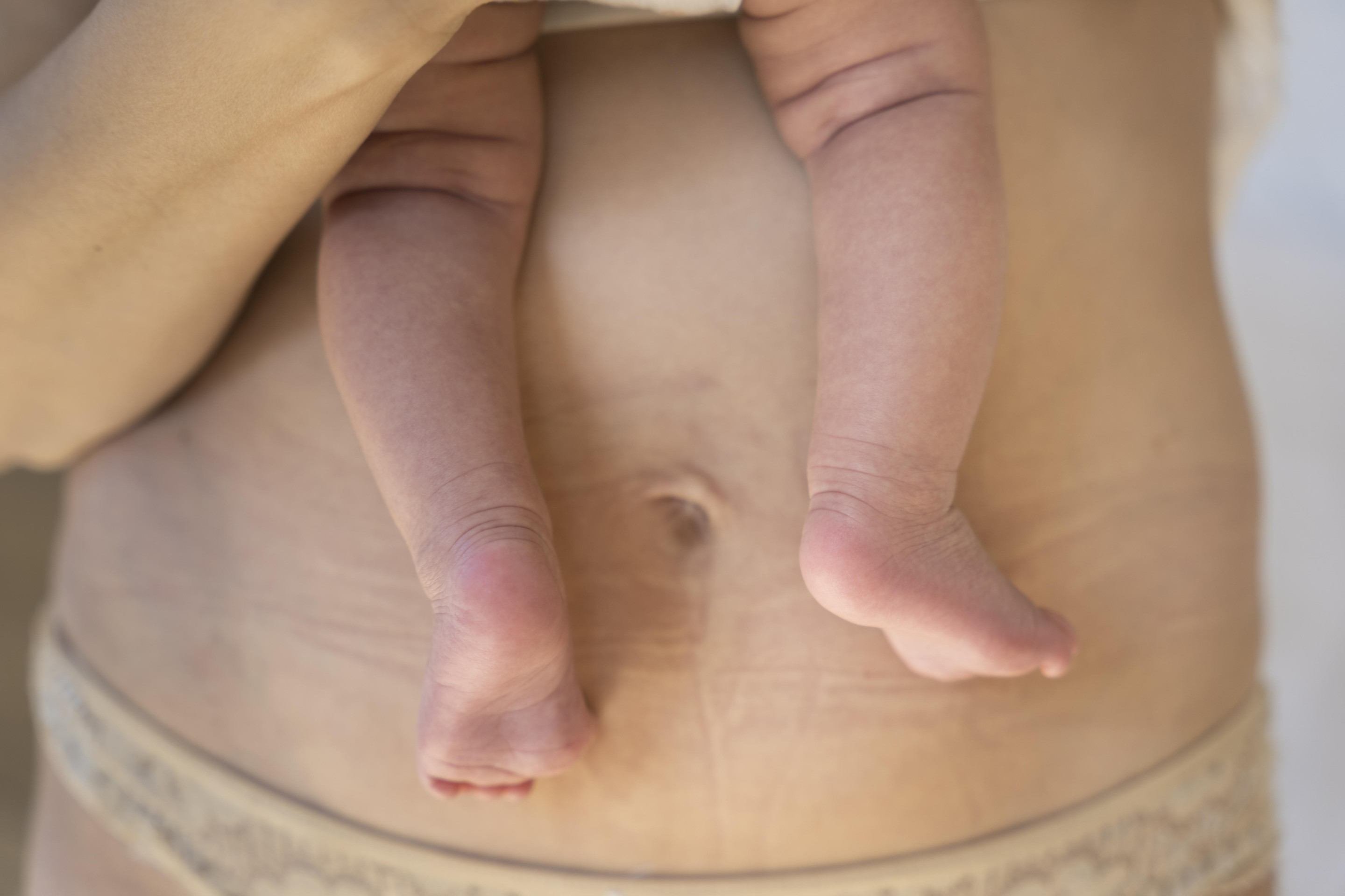 Musculatura frágil e comprometida: conheça a diástase e seus riscos