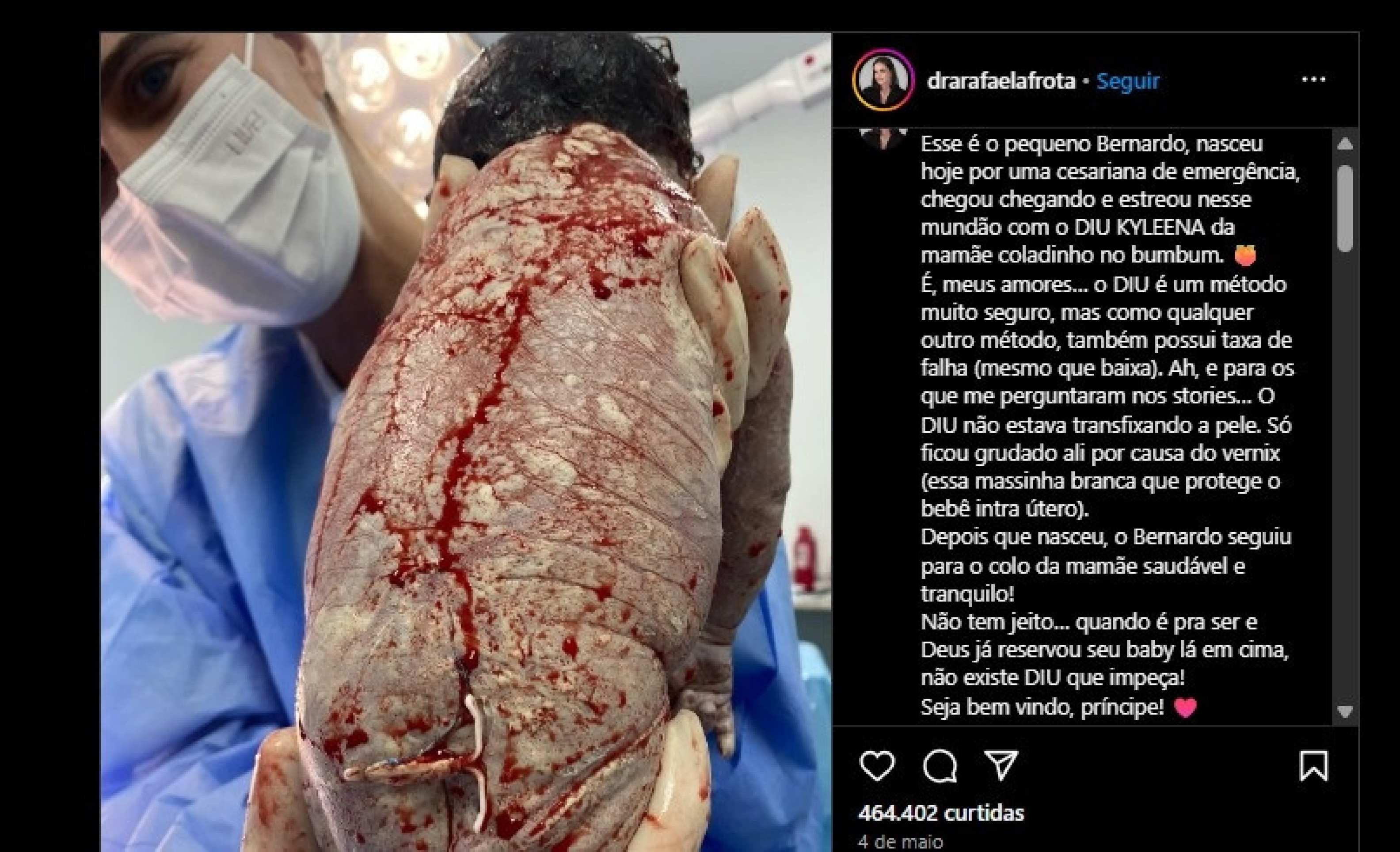 Mulher engravida com DIU e bebê nasce com dispositivo nas costas