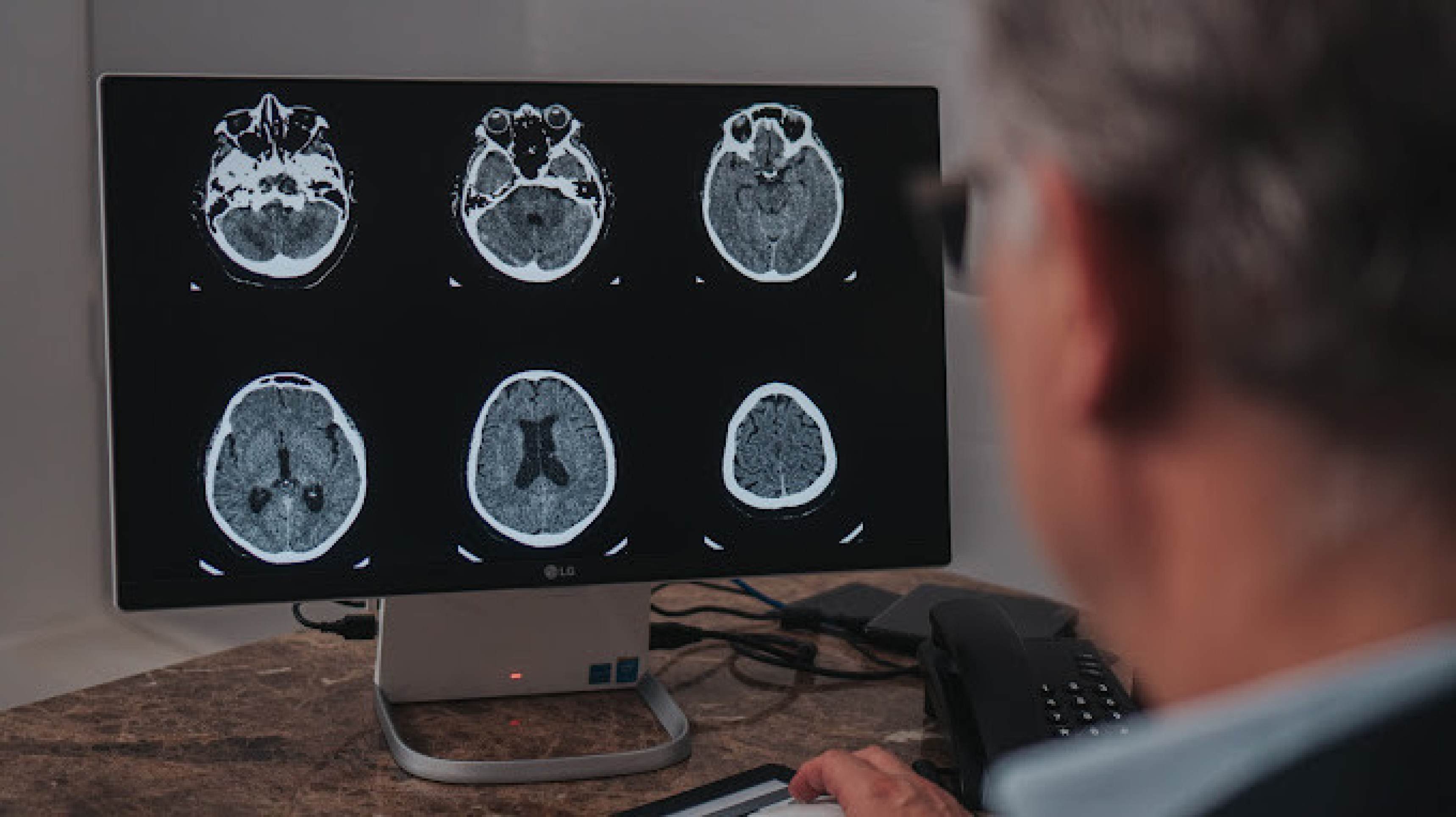 Terapia experimental usa vírus modificado para ativar o sistema imunológico, infiltrar células de defesa no tumor e aumentar a vida de pacientes com o câncer cerebral mais agressivo
 -  (crédito:  Vinny Campos)