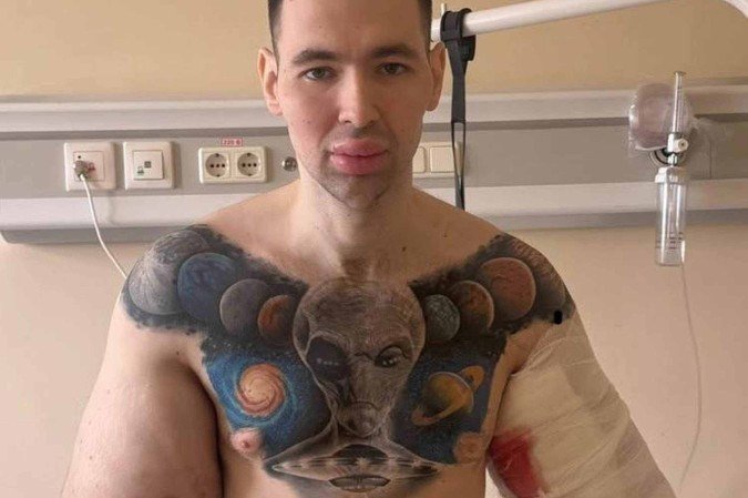 Influenciador russo a por cirurgia para retirar substâncias que injetou no bíceps - (crédito: Reprodução/Instagram) Influenciador russo a por cirurgia para retirar substâncias que injetou no bíceps - (crédito: Reprodução/Instagram)