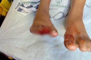 Menino de 9 anos é atacado por piranha em Caldas Novas -  (crédito: Material cedido ao Correio)