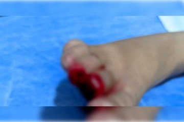 A criança sentiu uma forte dor no pé direito e, quando o tirou da água, viu que os dois dedos haviam sido decepados -  (crédito: Material cedido ao Correio)