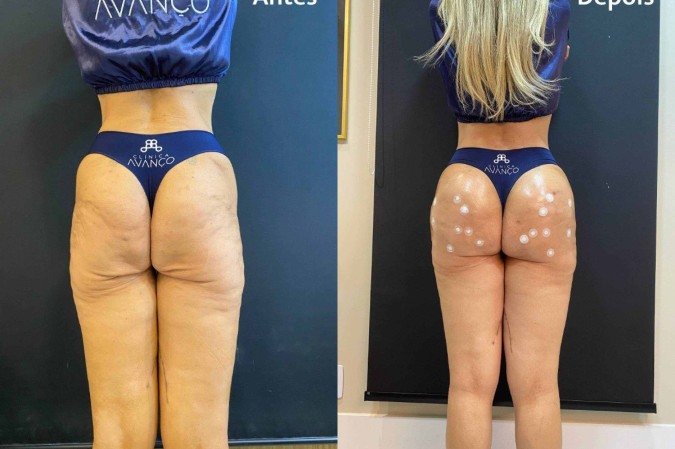 Harmonização glútea corrige flacidez após bariátrica -  (crédito: Reprodução/divulgação)