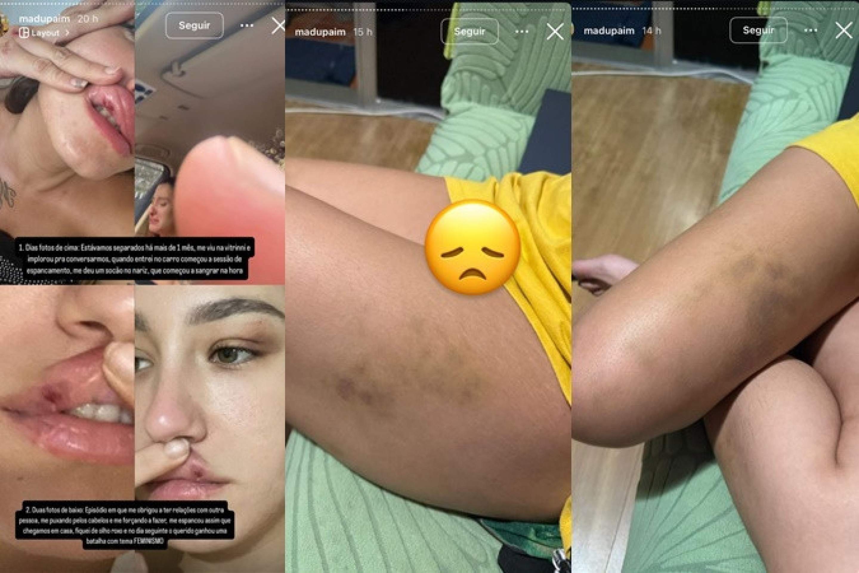 Fotos divulgadas por Madu Paim, das agressões sofridas
