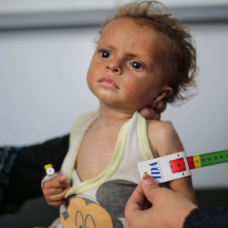  A malnourished Palestinian child is examined at Al-Awda hospital in the Nuseirat refugee camp in the central Gaza Strip on June 30, 2025. After more than 20 months of devastating conflict between Israel and the Hamas Islamist militant movement, rights groups say Gaza's population of more than two million face famine-like conditions. (Photo by Eyad BABA / AFP)       