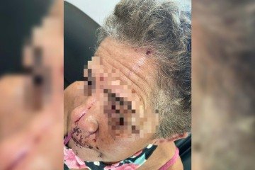A mulher teve um ferimento de aproximadamente 1 cm e sangramento contido - (crédito: Material cedido ao Correio) A mulher teve um ferimento de aproximadamente 1 cm e sangramento contido - (crédito: Material cedido ao Correio)
