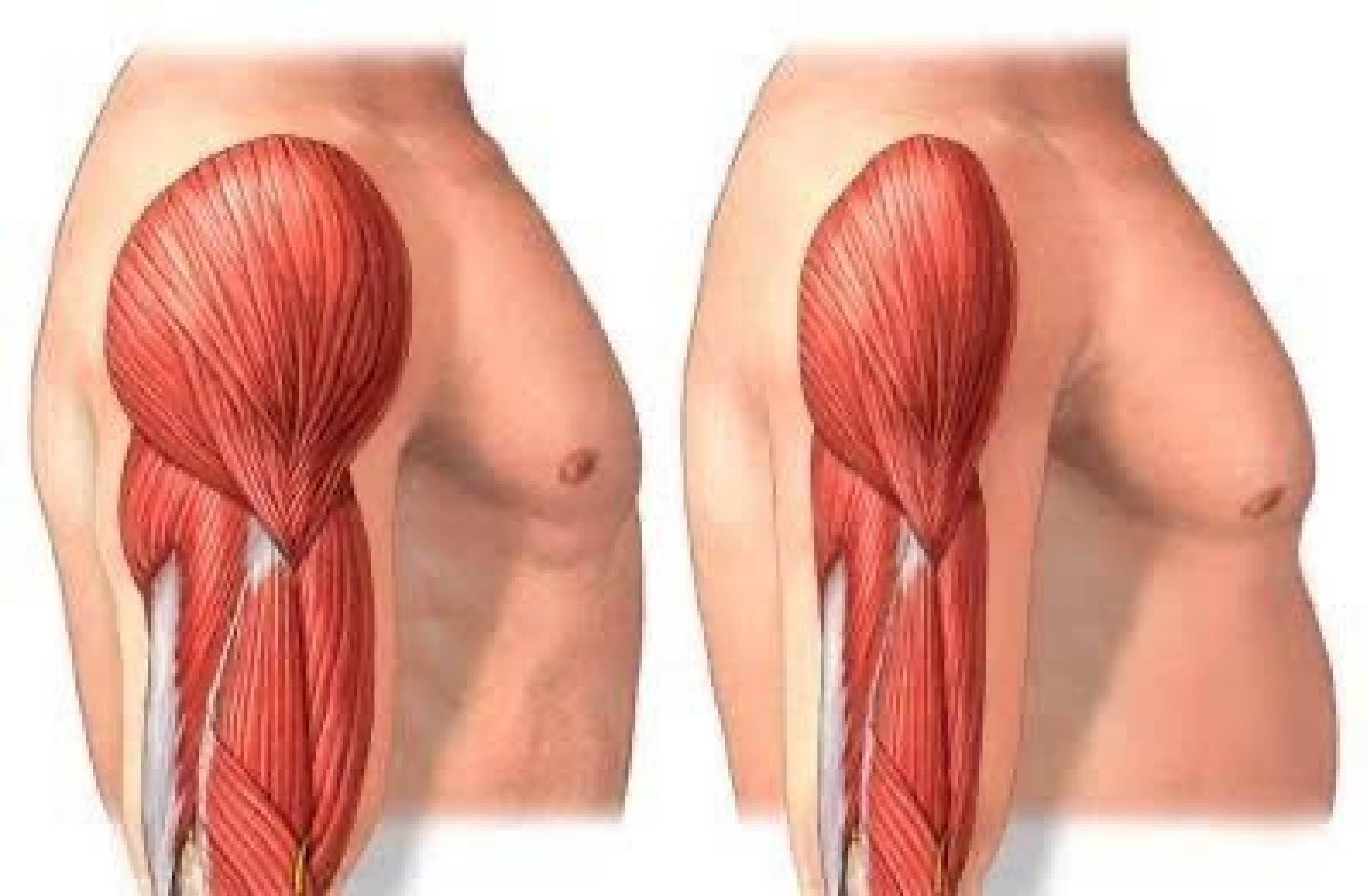 Comparação entre um corpo saudável e outro com sarcopenia 