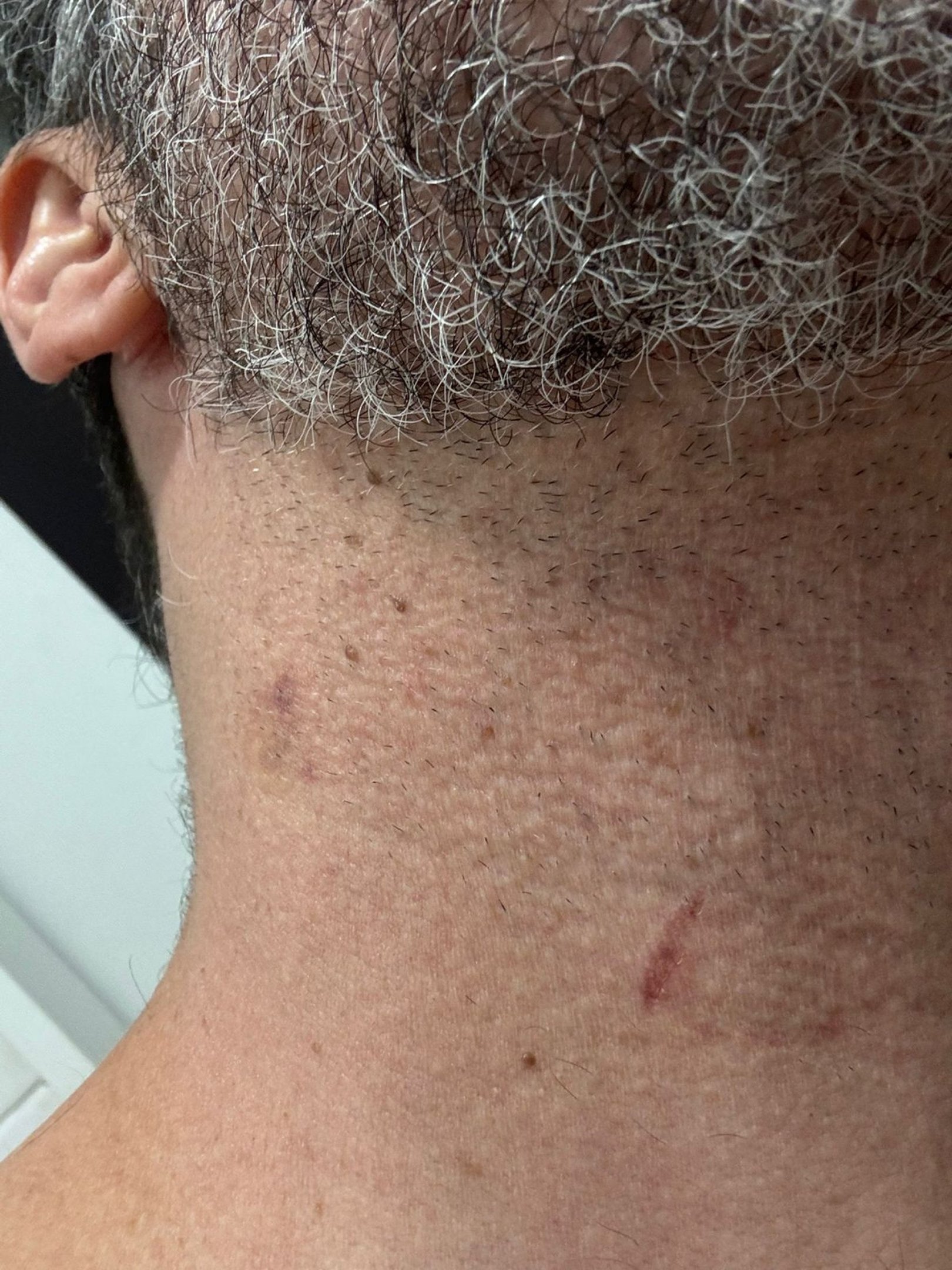Diego mostrou as marcas deixadas pelo mata-leão 