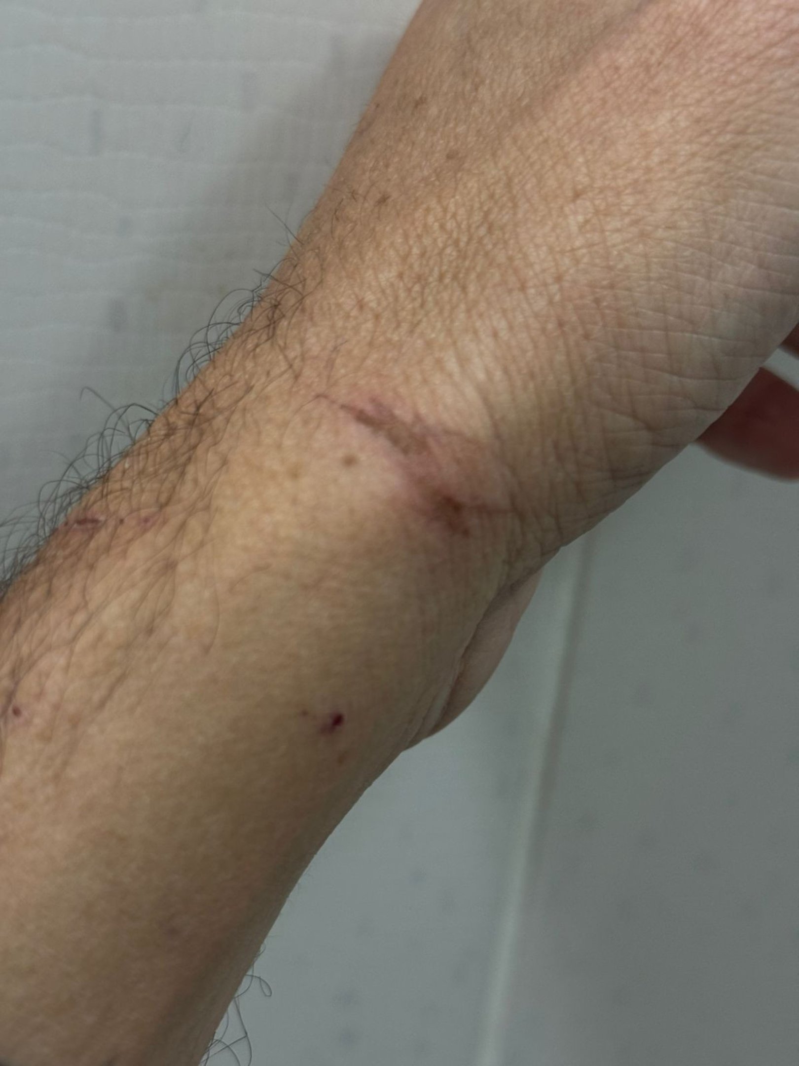 Hematoma causado pela abordagem truculenta dos policiais
