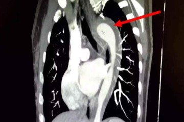 Tomografia de tórax mostra o hematoma intramural da aorta torácica -  (crédito: Reprodução/American Journal of Case Reports)