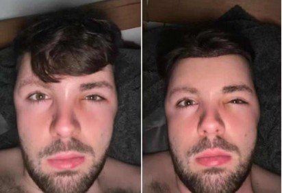 Ruben Owen compartilhou o susto que viveu apÃ³s ignorar orientaÃ§Ãµes mÃ©dicas e fazer sexo dias depois de um transplante capilar -  (crédito: ReproduÃ§Ã£o / Instagram )