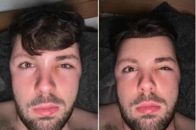 Ruben Owen compartilhou o susto que viveu após ignorar orientações médicas e fazer sexo dias depois de um transplante capilar - (crédito: Reprodução / Instagram ) Ruben Owen compartilhou o susto que viveu após ignorar orientações médicas e fazer sexo dias depois de um transplante capilar - (crédito: Reprodução / Instagram )