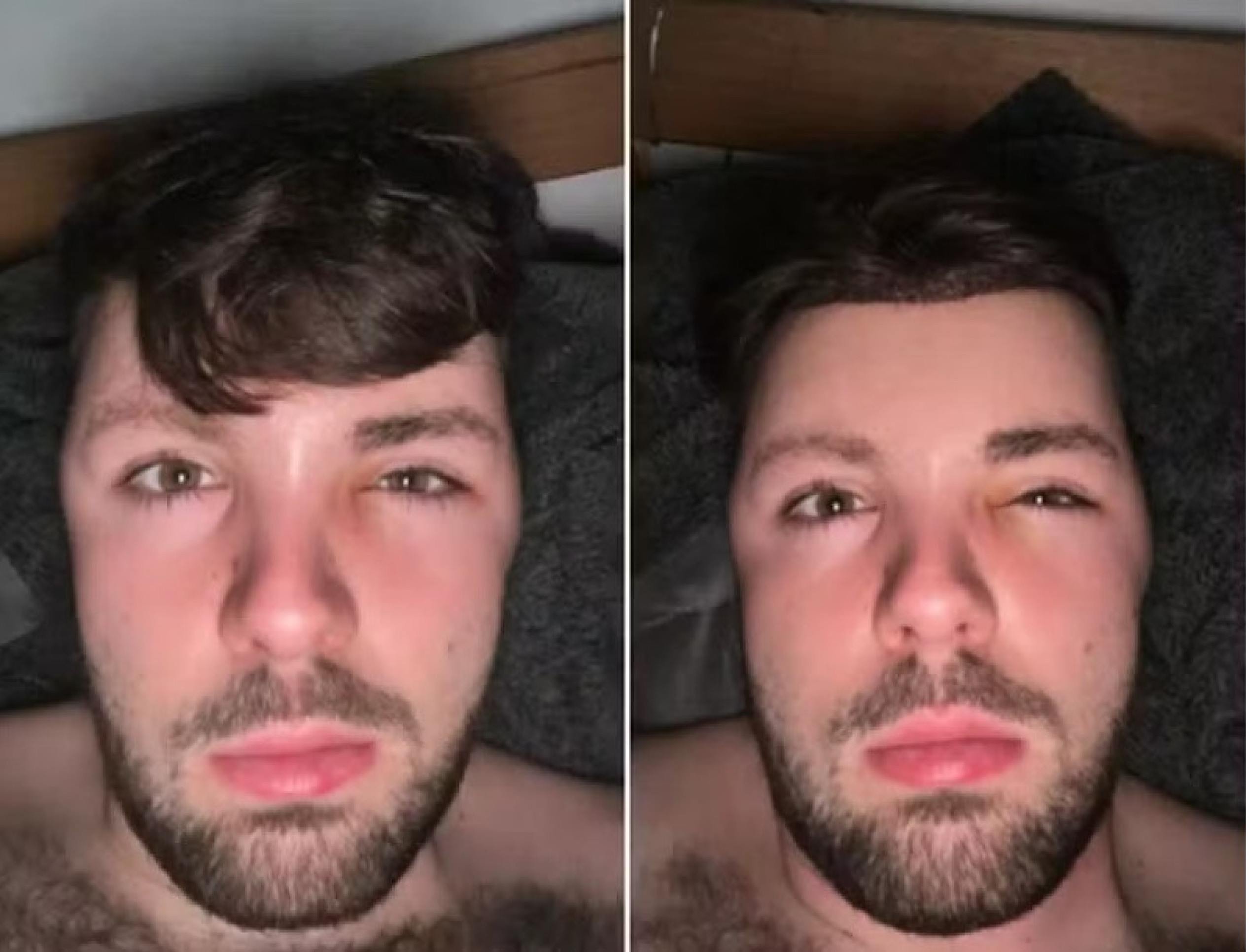 Homem faz sexo após transplante capilar e acorda com rosto deformado