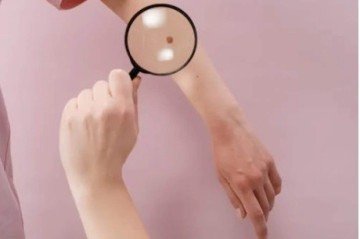 Apesar de sinais visíveis como manchas e pintas, 54% dos brasileiros nunca se consultaram com um dermatologista -  (crédito: Pexels)