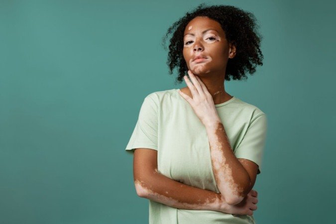 O vitiligo é caracterizado por áreas despigmentadas na pele (Imagem: Dean Drobot | Shutterstock) - (crédito: EdiCase) O vitiligo é caracterizado por áreas despigmentadas na pele (Imagem: Dean Drobot | Shutterstock) - (crédito: EdiCase)