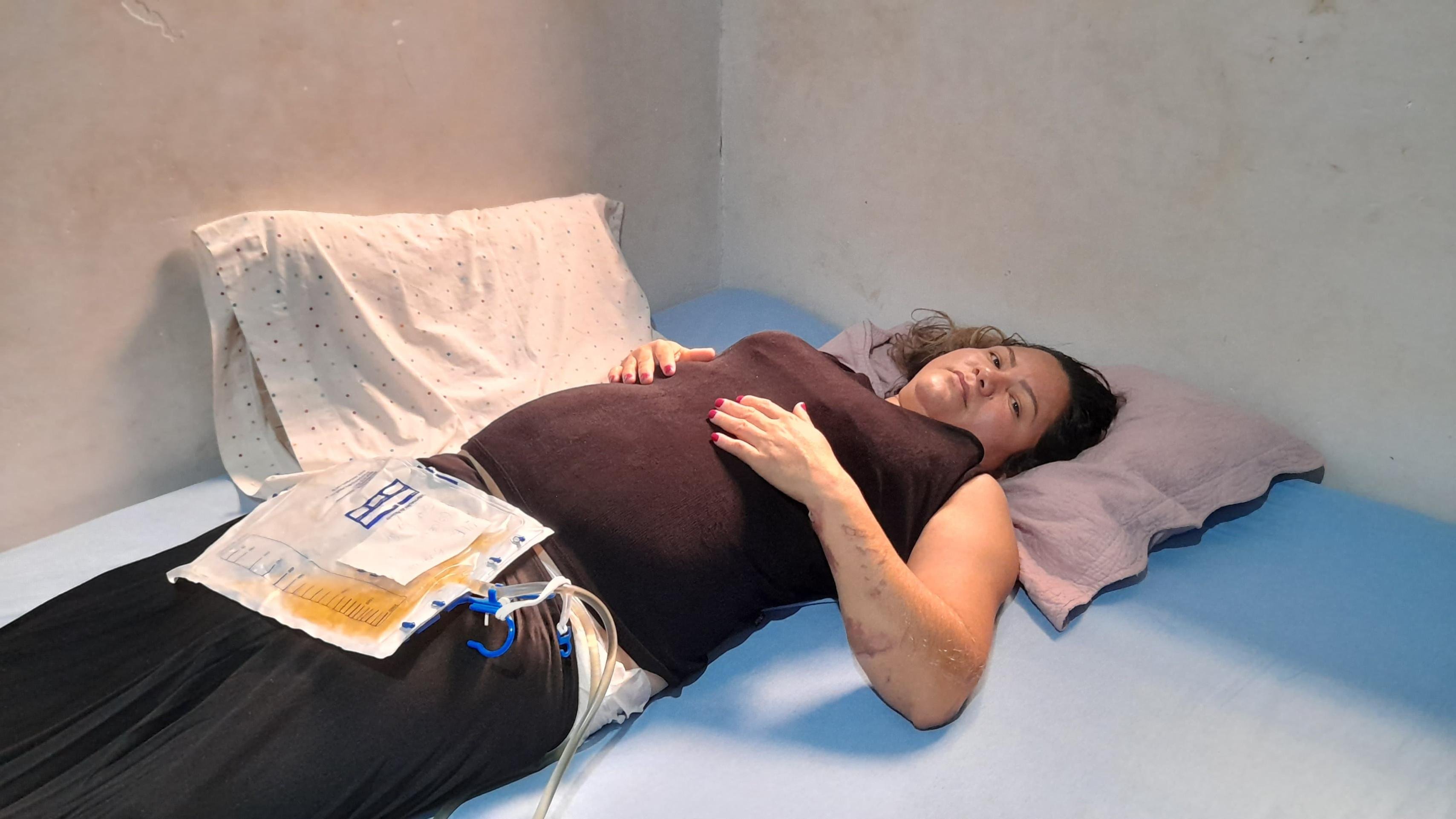 A autônoma Denise dos Santos foi atingida pelo carro desgovernado. Ela sofreu queimaduras de 2º grau e quebrou a bacia