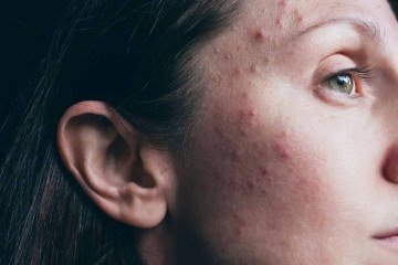 Sinais que podem indicar desequilíbrio hormonal em mulheres
 -  (crédito: Pinterest )