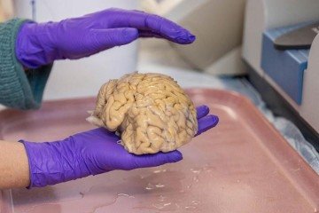 Cérebro de um superager estudado por cientistas da Universidade de Northwestern: padrões celulares distintos da população em geral é uma das causas da preservação cognitiva -  (crédito: Shane Collins/Northwestern University/Divulgação )