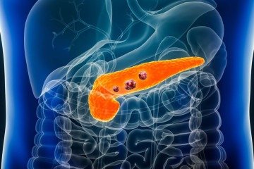 Noventa por cento dos pacientes de câncer pancreático têm mutações no gene Kras: vacina tem essas variantes como alvo -  (crédito: GettyImages/Divulgação )