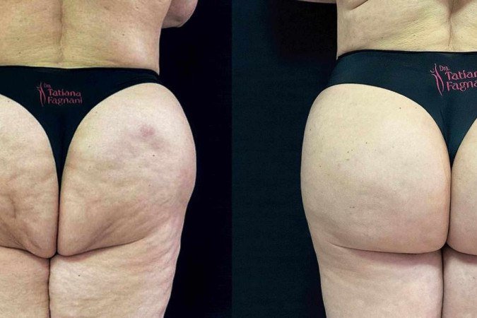 Antes da correção com PMMA, a paciente havia feito quatro lipoenxertias que geraram diversas sequelas.  
 -  (crédito: Divulgação)