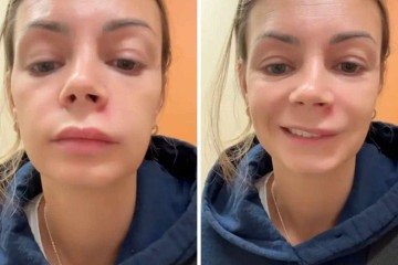 Como rosto de mulher ficou torto após espremer espinha -  (crédito: Reprodução / TikTok)