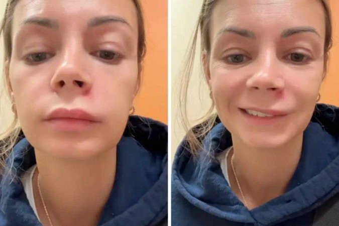 Como rosto de mulher ficou torto após espremer espinha - (crédito: Reprodução / TikTok) Como rosto de mulher ficou torto após espremer espinha - (crédito: Reprodução / TikTok)